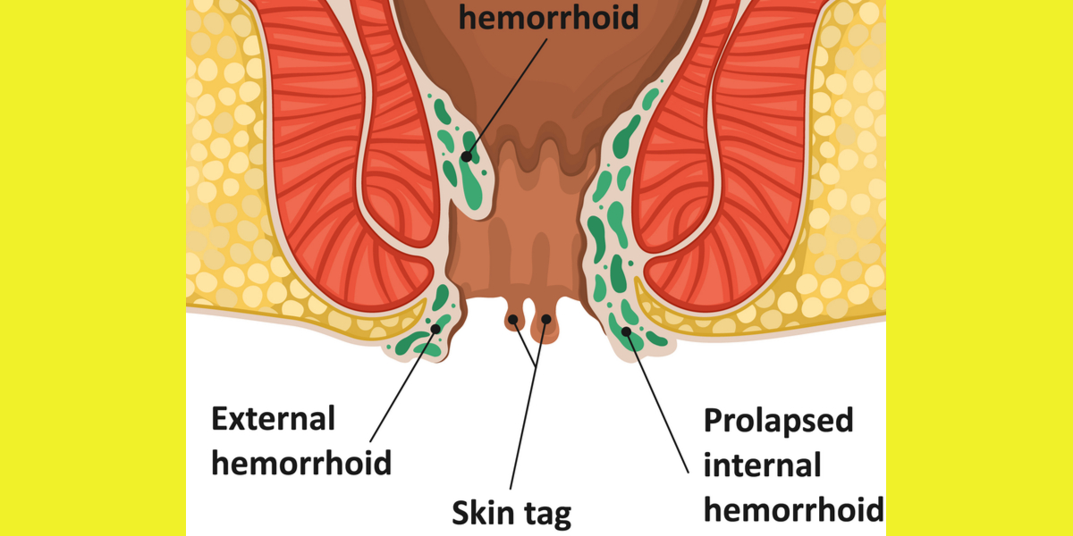 Unlike anal skin tags, hemorrhoids can be itchy and painful so treat them with hemorrhoid medications that you can get online in the UK from Pharmacy Planet.