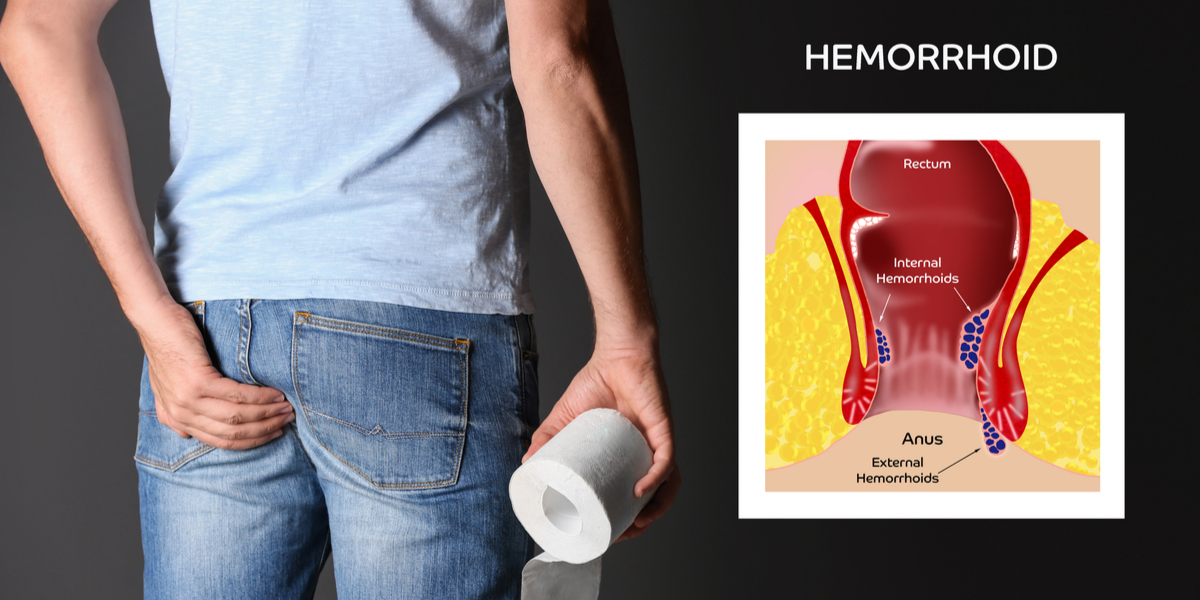 Visit Pharmacy Planet to learn more about internal hemorrhoids vs external hemorrhoids and buy Proctosedyl Ointment, Scheriproct, and Xyloproct online in the UK.